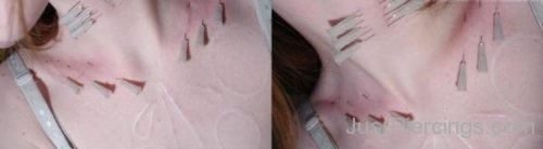 Collar Bone Piercing WIth Injections-JP1090